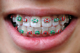 elastic rubber for braces
