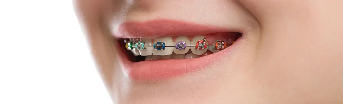 INVISALIGN AND BRACES IN RENTON, WA