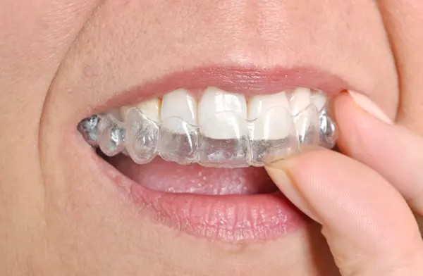invisalign clear aligners everything you need to know renton wa