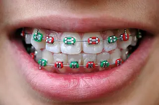 A Colorful Perspective About Braces Rubber Band Elastics
