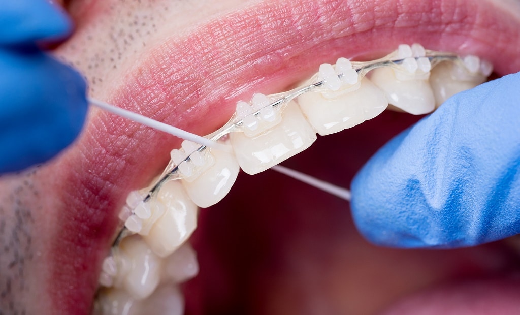 How to Floss with Braces Lasley Orthodontics