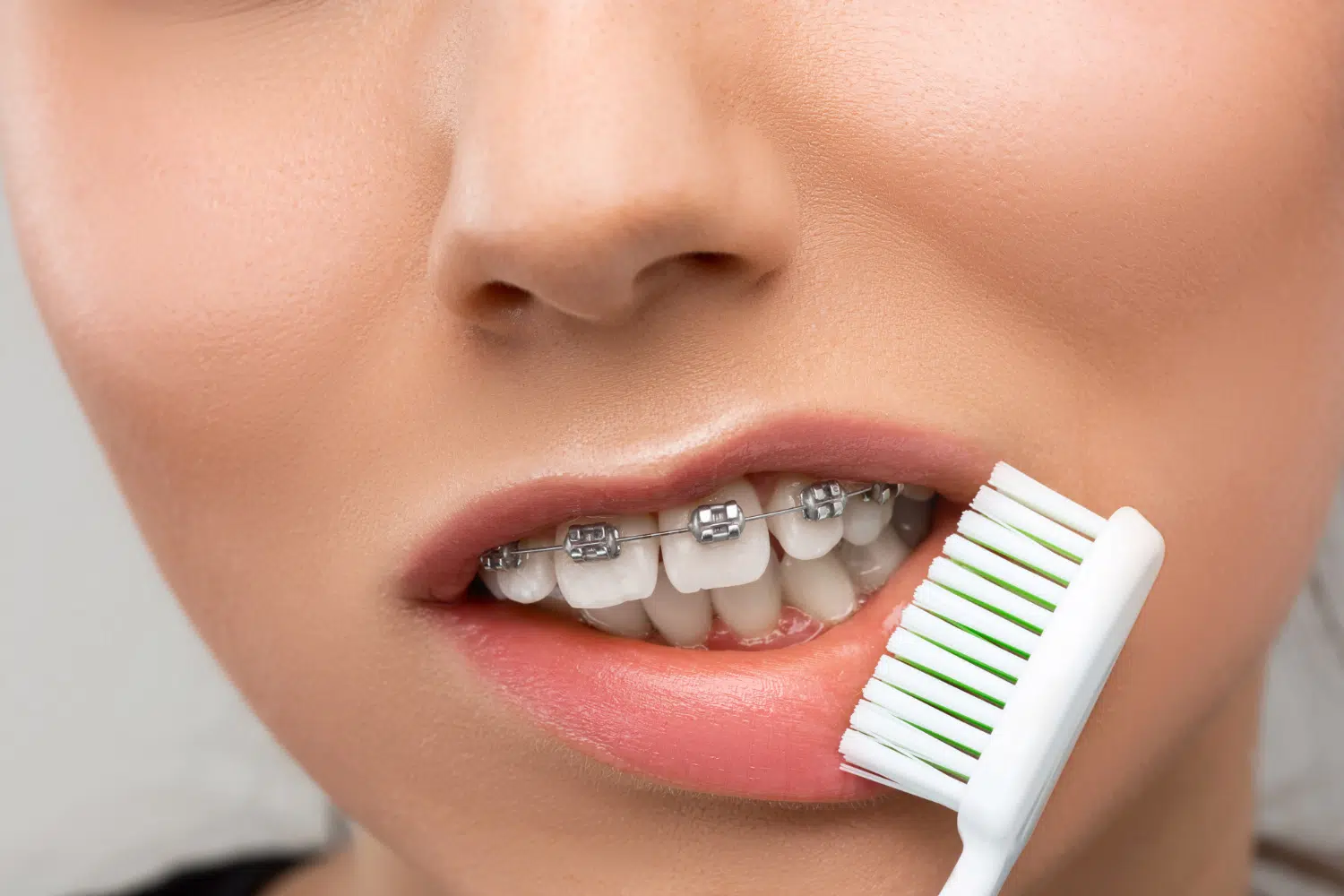 Tooth Decay with Braces: Proven Methods to Keep Cavities at Bay