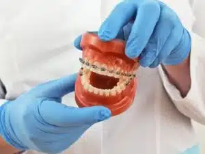 Braces Treatment