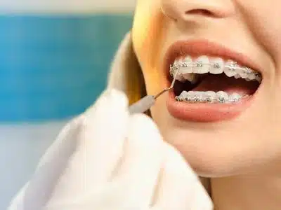 Braces Treatment