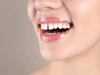 Gap Between Teeth