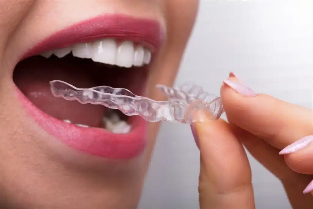 clear aligners Renton WA