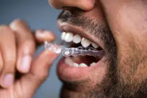 Invisalign for Dentures: Expert Insights on Combining Treatments