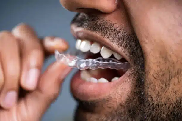 Invisalign for Dentures: Expert Insights on Combining Treatments