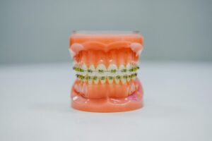 Braces Allergies: Essential Solutions for a Comfortable Treatment