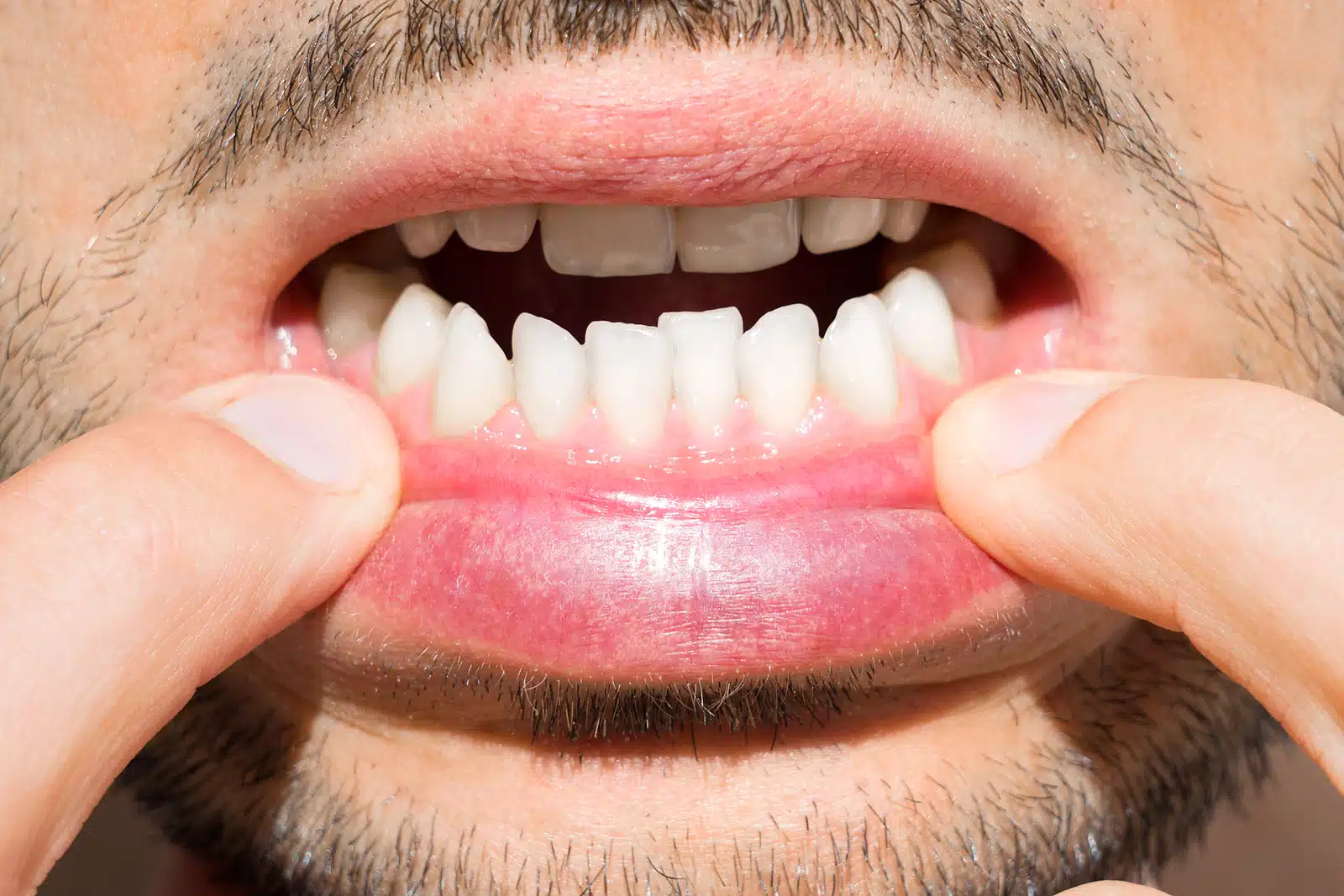 10 common signs you need braces