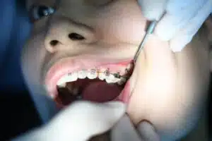 crooked teeth symptoms and orthodontic problems