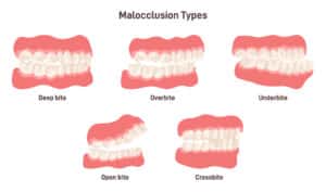 when to get braces for crowded teeth
