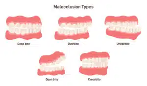 when to get braces for crowded teeth