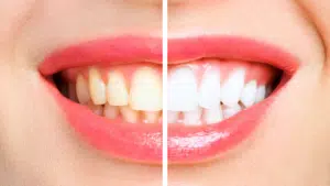 Teeth Whitening in Renton WA