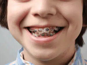 Types of Braces for kids’ teeth