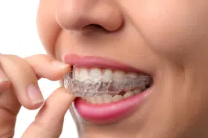 Patient inserting clear tray aligner showing Invisalign buttons on teeth for added control