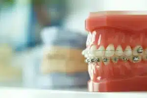 Braces used to improve bite position and jaw alignment