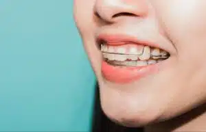 Patient wearing retainers