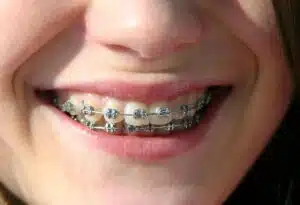 close-up of traditional metal braces on teeth in Renton WA