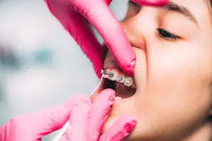 orthodontist adjusting traditional metal braces in Renton WA