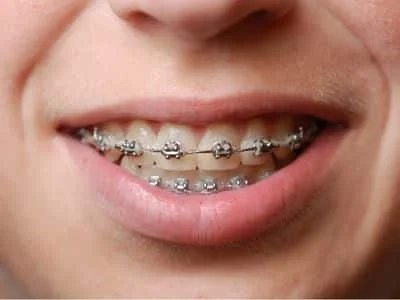 Life after braces